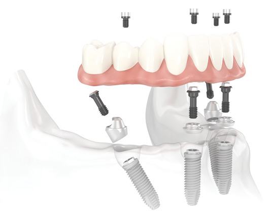 All-in-4 Implants